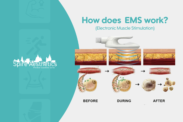 EMS treatment for post pregnancy weight loss treatment Leigh on Sea