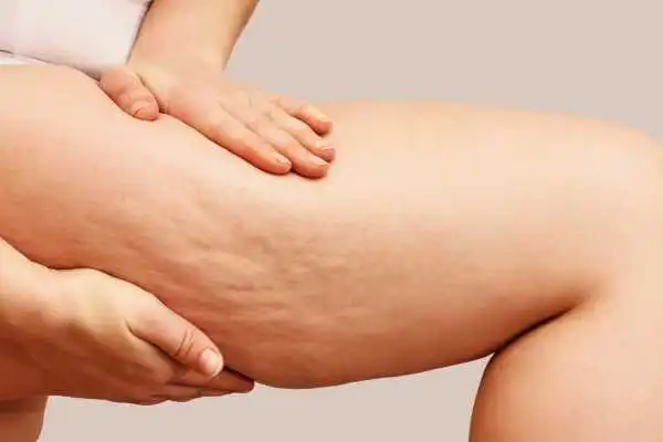 Image of woman showing leg with cellulite Leigh on Sea