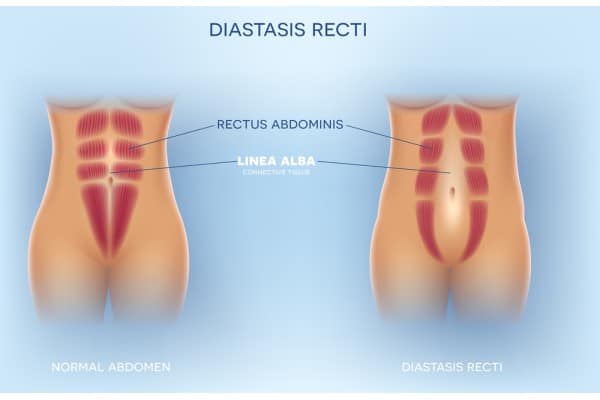 What Non-Surgical Options Are Available for Diastasis Recti Leigh on Sea?