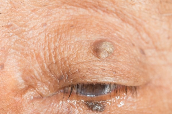 Skin imperfections Leigh on Sea - Cryopen is fast and effective book in today!
