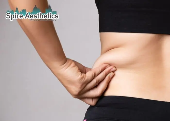 Image of woman pinching fat on their hips Leigh on Sea. Fat Freezing treatment