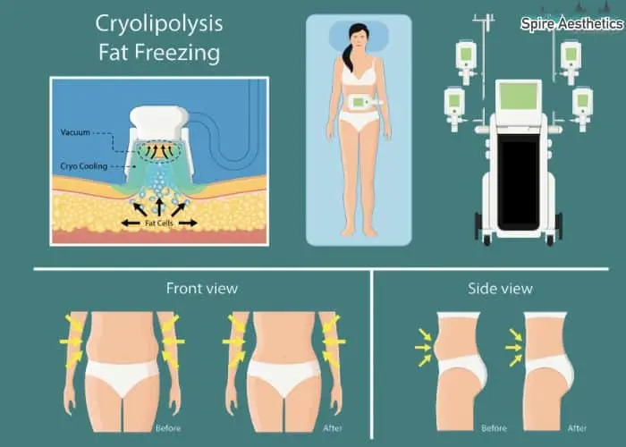 Fat freezing treatment Leigh on Sea benefits for competitions to remove stubborn fat deposits.