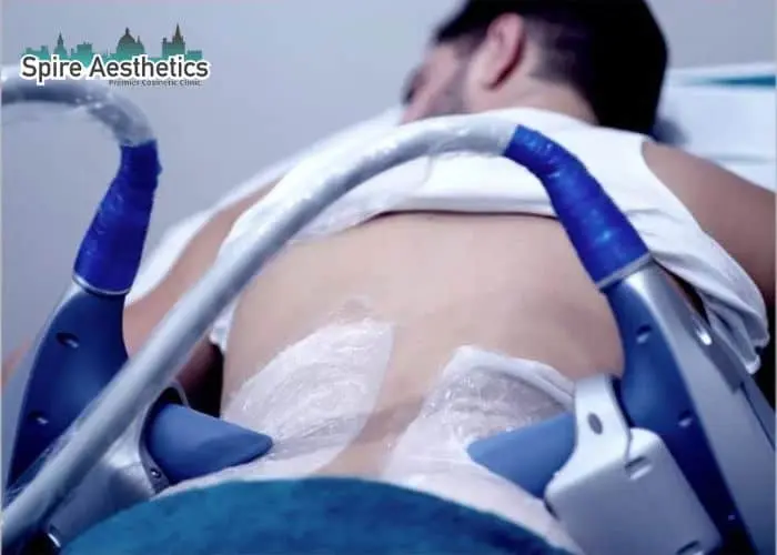 Man having fat freezing treatment done on love handles before a competitions Leigh on Sea to create a sculpted look.