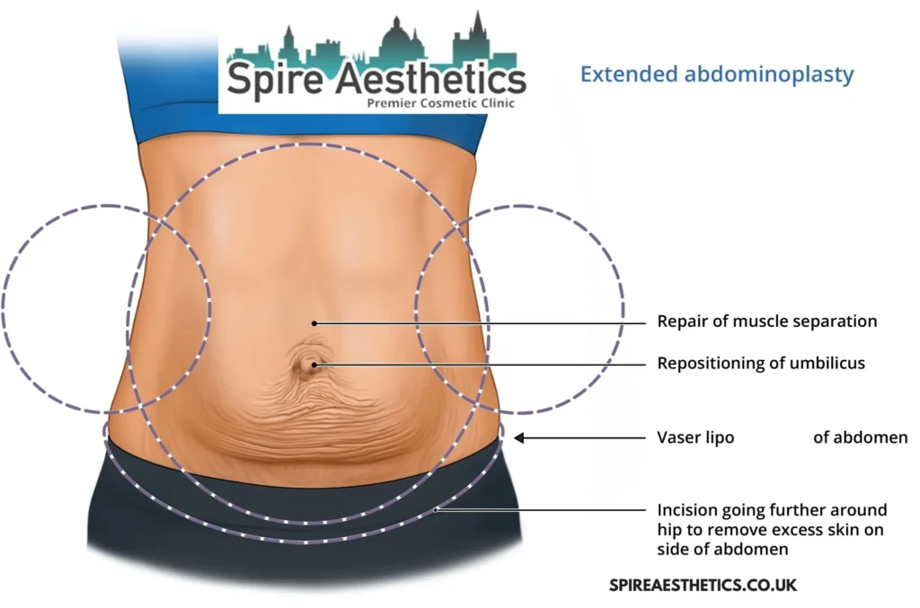 Understanding Loose Skin After Gastric Band Leigh on Sea Surgery and HIFU Treatment
