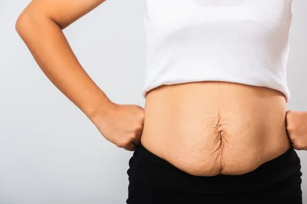 Image of a woman's stomach after weight loss with sagging skin following a gastric band Leigh on Sea