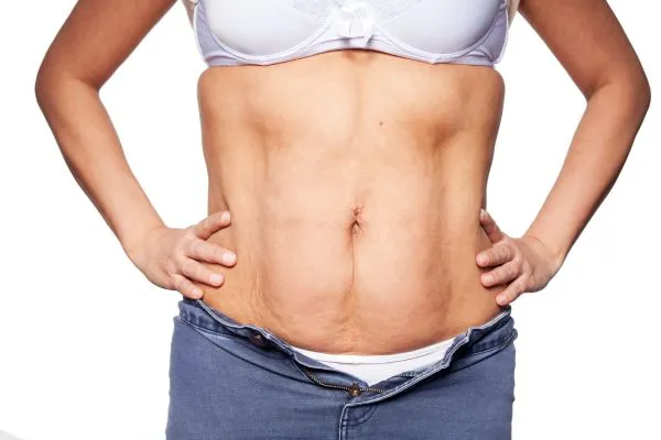 sagging skin on woman's stomach after weight loss injections Leigh on Sea