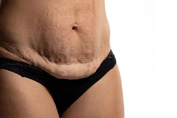 Image of womans stomach after weight loss injections Leigh on Sea showing saggy skin