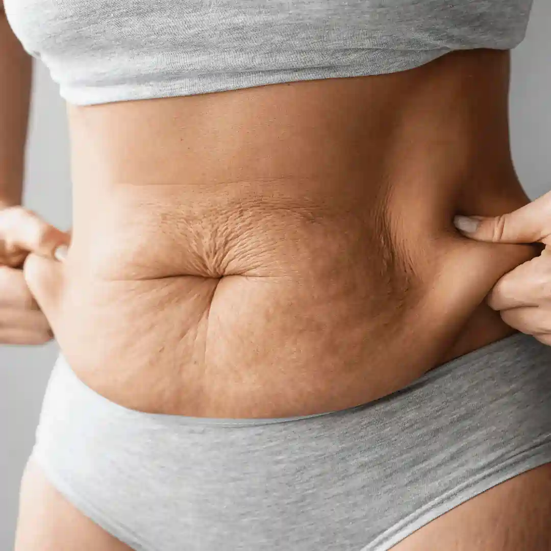 Is It Normal to Have Loose Skin After Pregnancy Leigh on Sea?