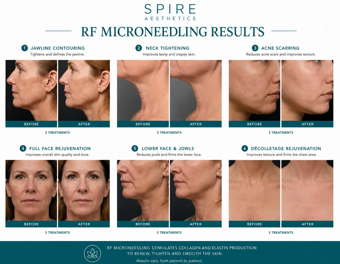 RF Microneedling Skin tightening Leigh on Sea results