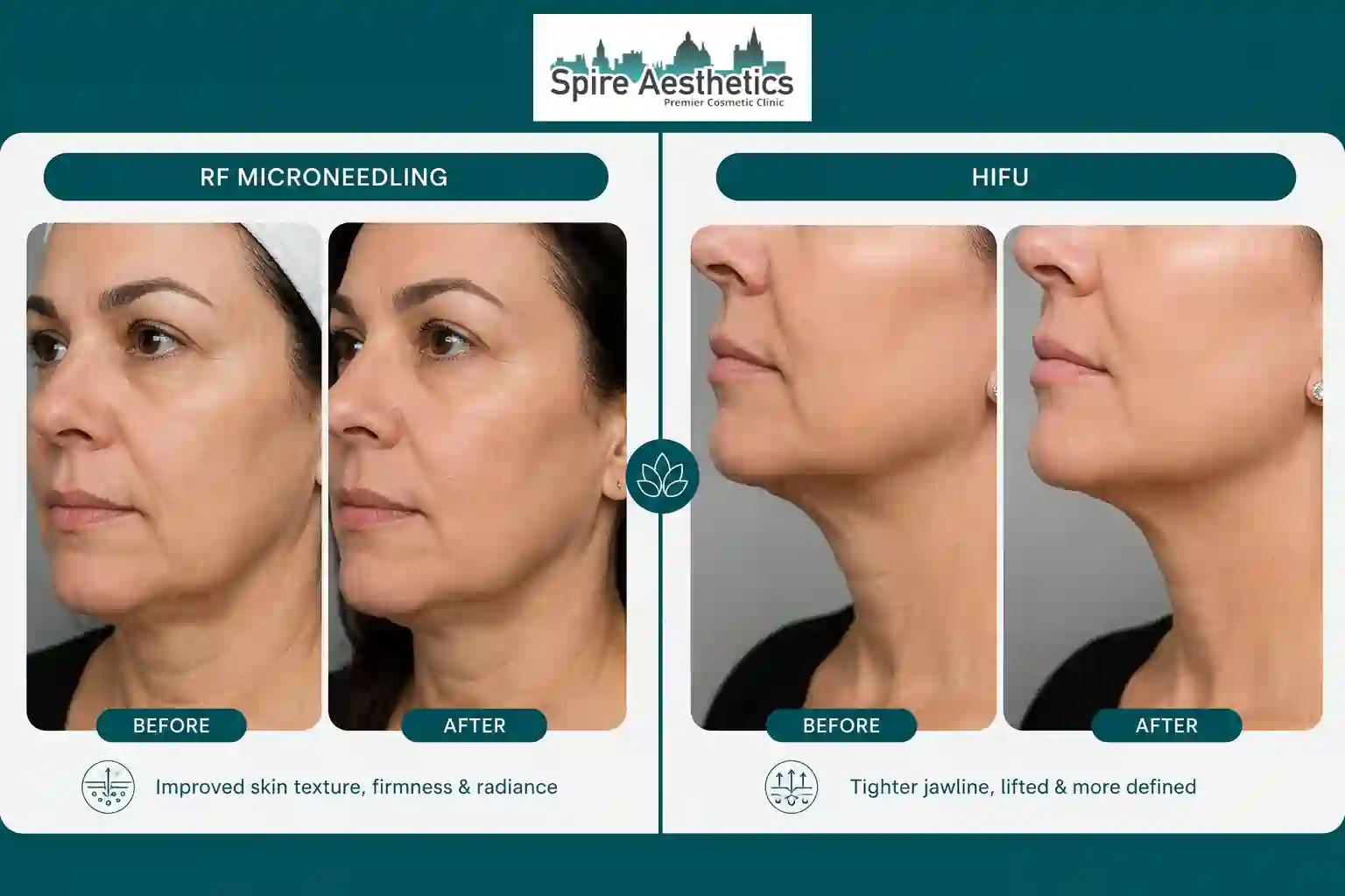 Can RF Microneedling and HIFU Be Combined Leigh on Sea?