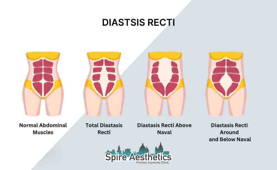 Is Non-Surgical Diastasis Recti Treatment Right for You? Common Concerns Answered Leigh on Sea